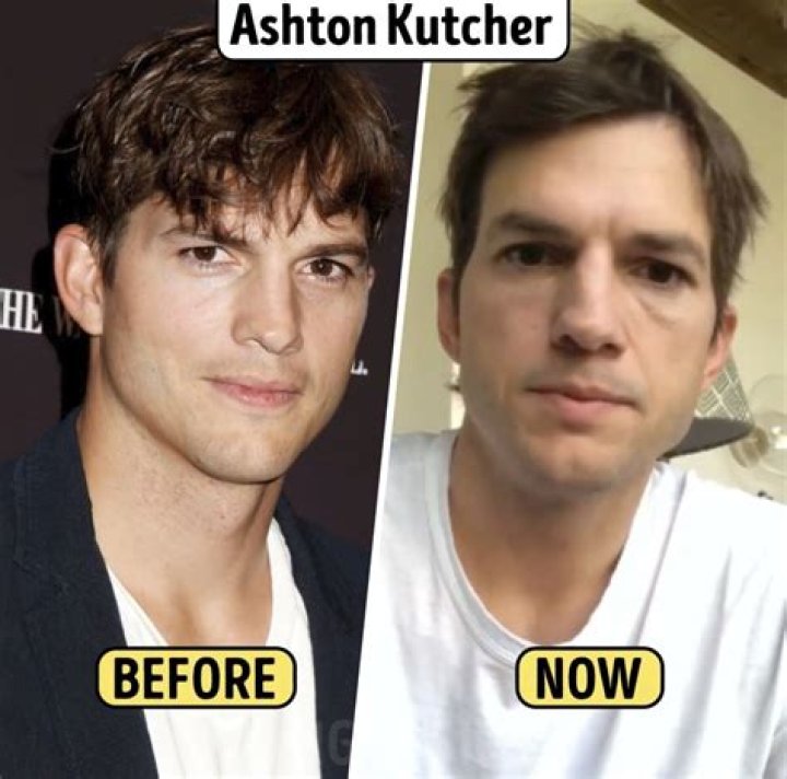 Ashton Kutcher is using plastic surgery too?