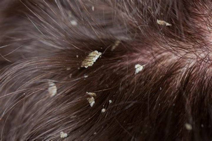 Lice